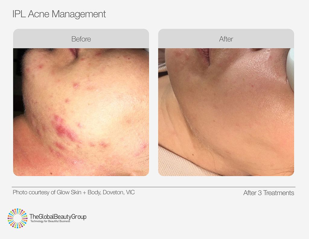 IPL acne Treatment Australia