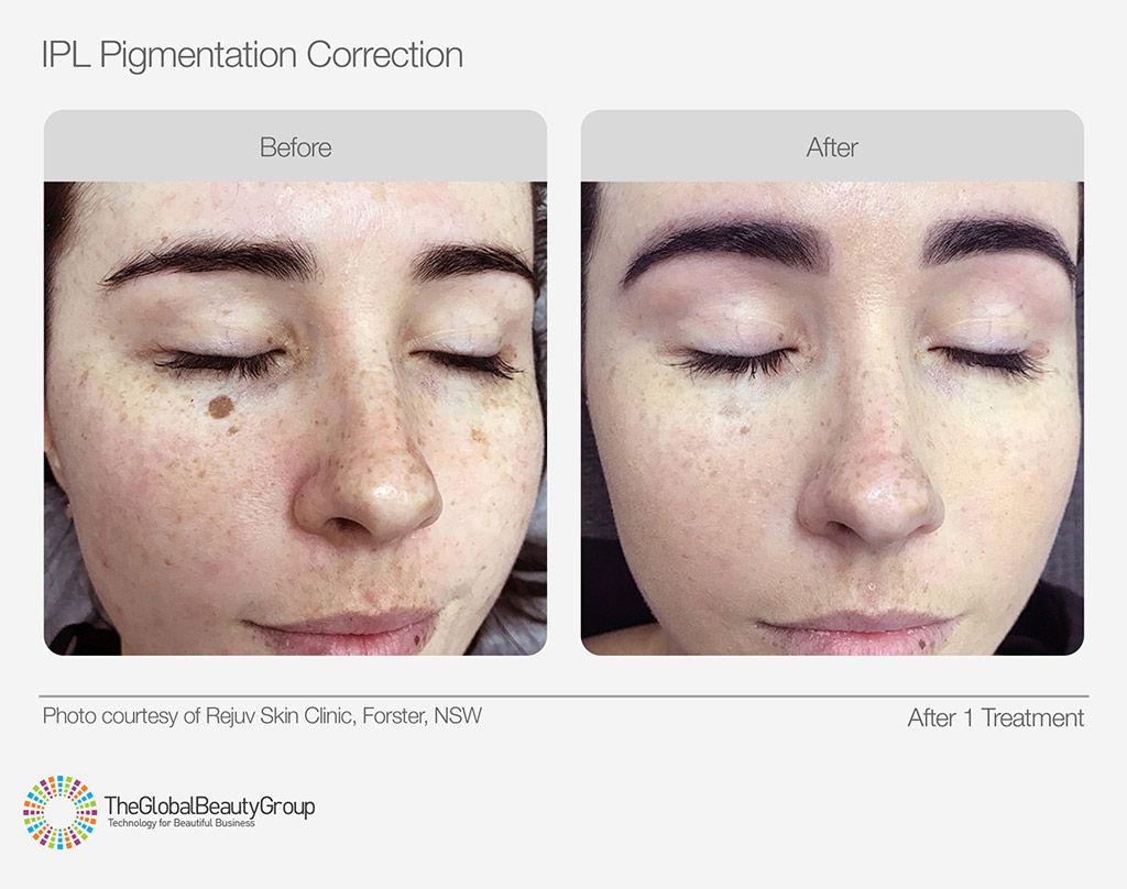 IPL Skin Pigmentation