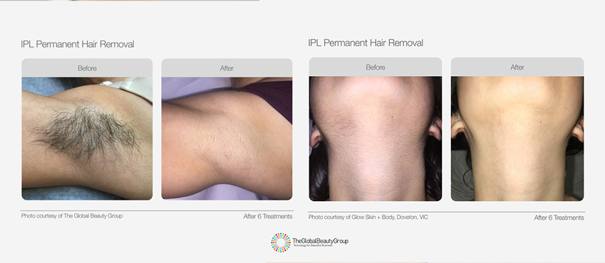 Permanent Hair Removal Treatment