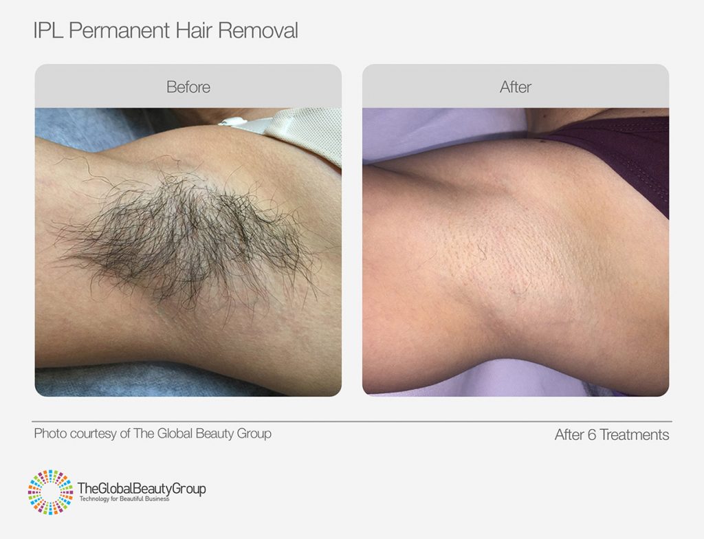 SHR Hair Removal Carnegie